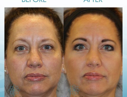 Vampire Facials (PRP) Versus PRF