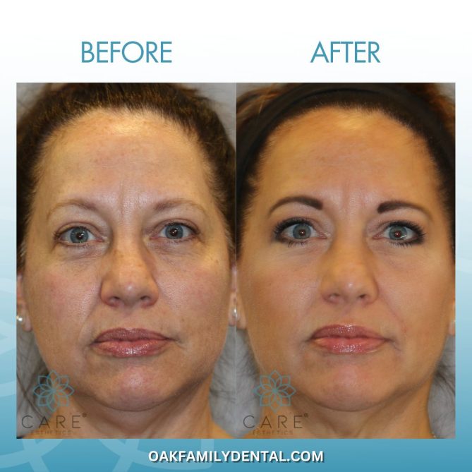 prf treatment